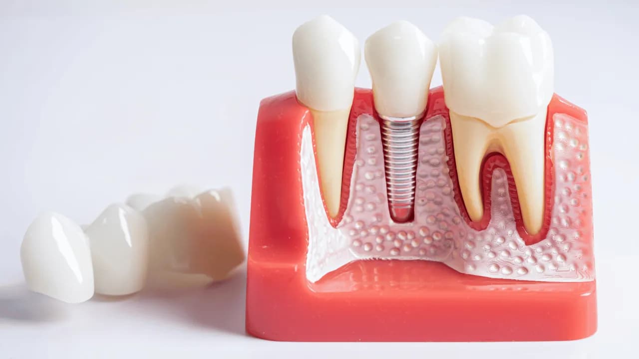 Jak długo wytrzymują implanty zębów? Poznaj fakty i czynniki wpływające na trwałość Jak długo wytrzymują implanty zębów? Poznaj fakty i czynniki wpływające na trwałość