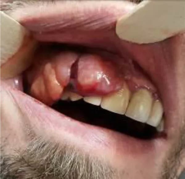 Czerniak jamy ustnej objawy – jak je rozpoznać i nie przegapić Czerniak jamy ustnej objawy – jak je rozpoznać i nie przegapić