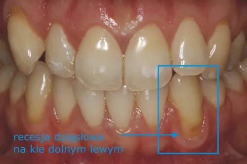Recesja dziąseł objawy: Jak rozpoznać niepokojące symptomy? Recesja dziąseł objawy: Jak rozpoznać niepokojące symptomy?