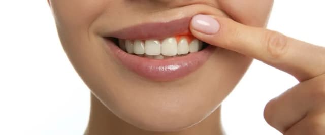 Jak skutecznie leczyć zapalenie dziąseł w ciąży bez ryzyka dla płodu Jak skutecznie leczyć zapalenie dziąseł w ciąży bez ryzyka dla płodu