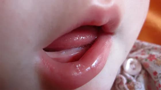 Jak wyglądają dziąsła niemowlaka przy ząbkowaniu - zdjęcia i objawy Jak wyglądają dziąsła niemowlaka przy ząbkowaniu - zdjęcia i objawy