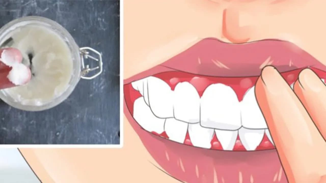 Skuteczne sposoby na dziąsła: jak złagodzić ból i zapalenie Skuteczne sposoby na dziąsła: jak złagodzić ból i zapalenie