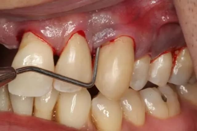 Skuteczne sposoby na bolące dziąsła w ciąży, które przynoszą ulgę Skuteczne sposoby na bolące dziąsła w ciąży, które przynoszą ulgę