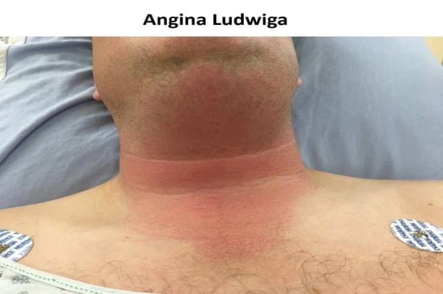 Objawy ropowicy dna jamy ustnej – jak je rozpoznać i unikać powikłań Objawy ropowicy dna jamy ustnej – jak je rozpoznać i unikać powikłań