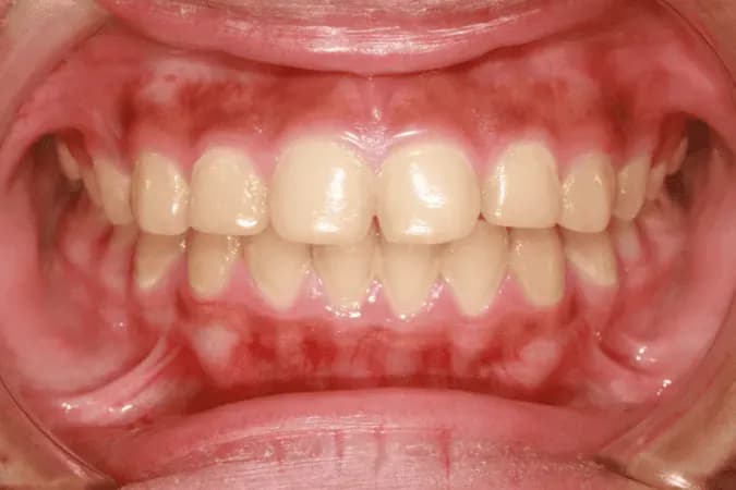 Jak wyglądają zdrowe dziąsła? Oto cechy, które musisz znać Jak wyglądają zdrowe dziąsła? Oto cechy, które musisz znać