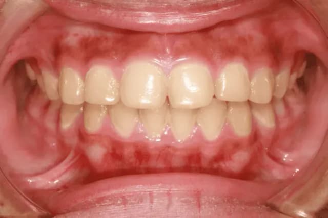 Jak wyglądają zdrowe dziąsła? Oto cechy, które musisz znać Jak wyglądają zdrowe dziąsła? Oto cechy, które musisz znać