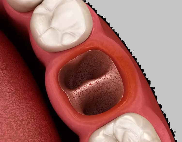 Ile krwawi dziąsło po wyrwaniu zęba? Sprawdź, co jest normalne Ile krwawi dziąsło po wyrwaniu zęba? Sprawdź, co jest normalne