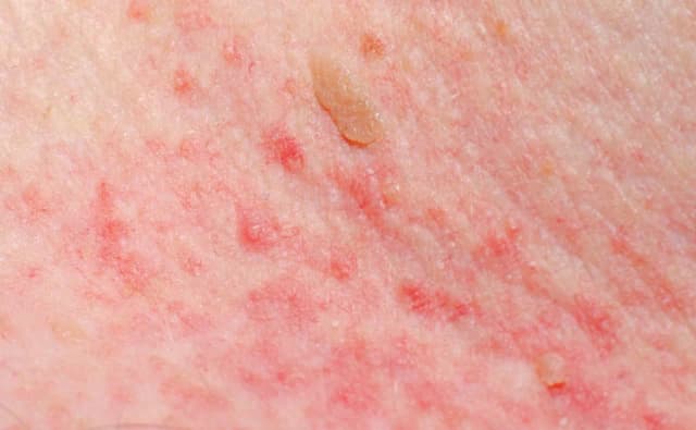 Skuteczne leki na asfaltówkę: ulga w objawach choroby pielgrzyma Skuteczne leki na asfaltówkę: ulga w objawach choroby pielgrzyma