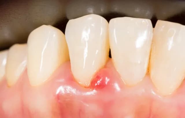 Jak wyleczyć zapalenie dziąseł i uniknąć bólu oraz powikłań Jak wyleczyć zapalenie dziąseł i uniknąć bólu oraz powikłań