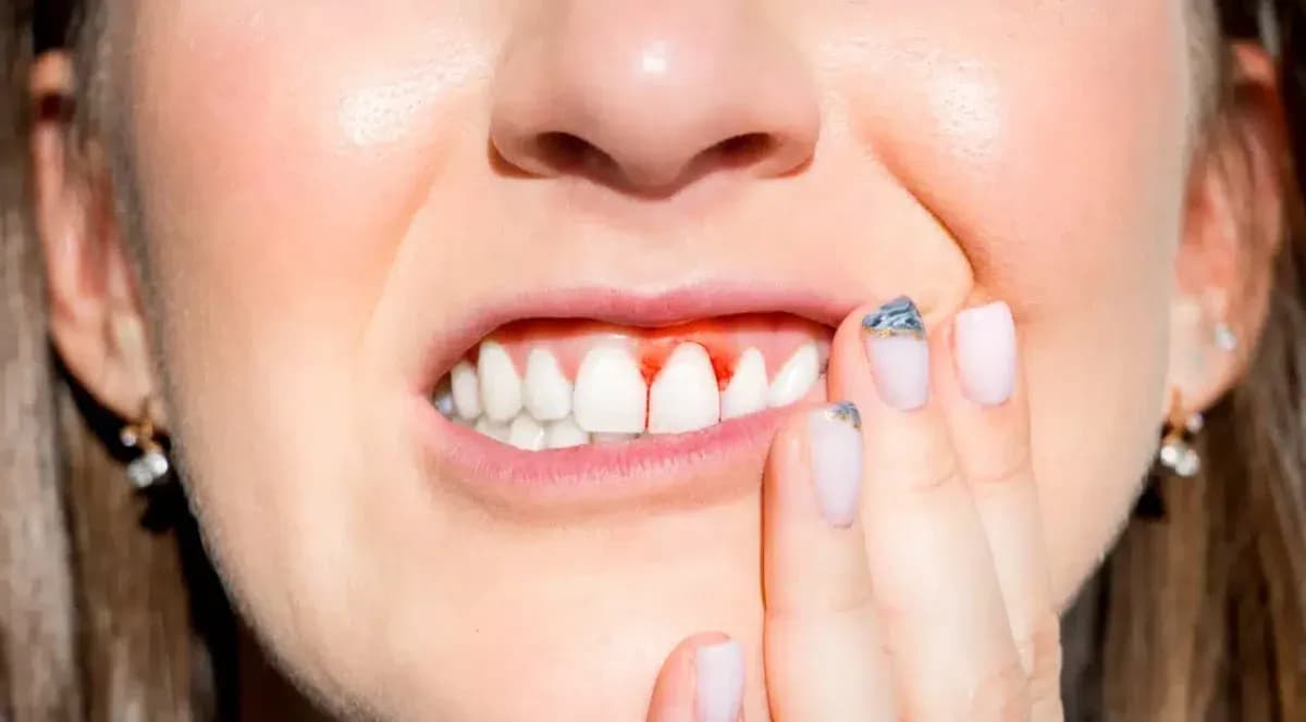 Skuteczne metody na krwawiące dziąsła - poznaj przyczyny i leczenie Skuteczne metody na krwawiące dziąsła - poznaj przyczyny i leczenie