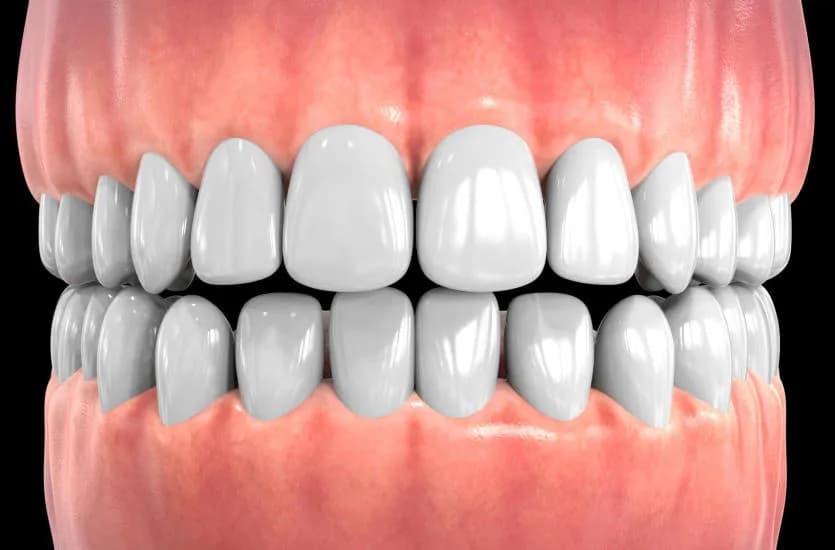 Skuteczne metody na stan zapalny dziąseł - jak uniknąć bólu i problemów Skuteczne metody na stan zapalny dziąseł - jak uniknąć bólu i problemów