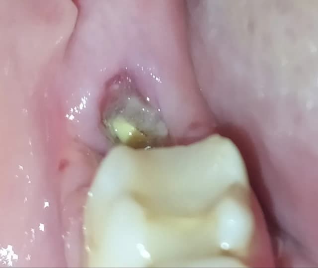 Jak goi się dziąsło po wyrwaniu zęba? Co musisz wiedzieć o bólu i komplikacjach Jak goi się dziąsło po wyrwaniu zęba? Co musisz wiedzieć o bólu i komplikacjach