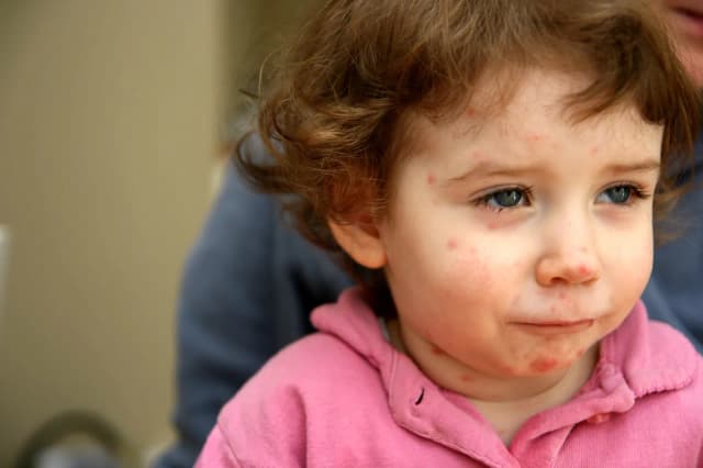 Skuteczne metody leczenia ospy w jamie ustnej i łagodzenia bólu Skuteczne metody leczenia ospy w jamie ustnej i łagodzenia bólu