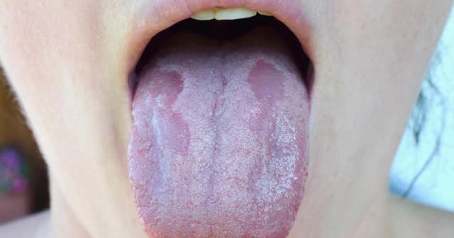 Grzybica jamy ustnej czy jest zaraźliwa? Sprawdź, jak się przenosi Grzybica jamy ustnej czy jest zaraźliwa? Sprawdź, jak się przenosi