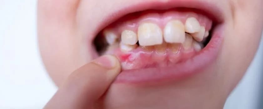 Zapalenie dziąseł u dziecka objawy - jak je rozpoznać i leczyć Zapalenie dziąseł u dziecka objawy - jak je rozpoznać i leczyć