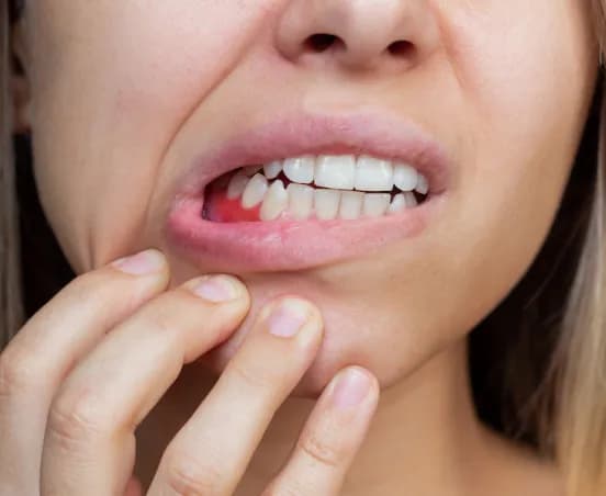 Czy rak dziąsła boli? Poznaj objawy i co robić w przypadku bólu Czy rak dziąsła boli? Poznaj objawy i co robić w przypadku bólu