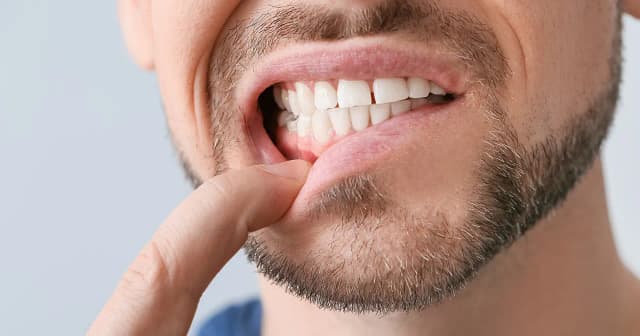 Zapalenie dziąseł co robić: skuteczne metody na ulgę i zdrowie Zapalenie dziąseł co robić: skuteczne metody na ulgę i zdrowie