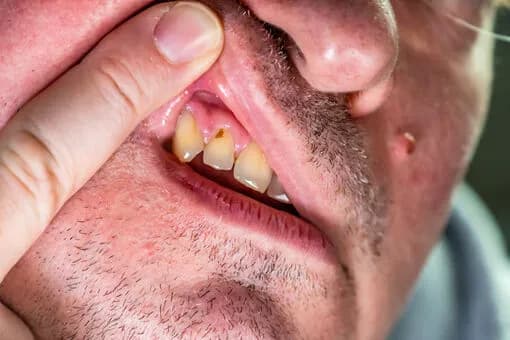 Jak usunąć ropę z dziąsła i uniknąć poważnych komplikacji zdrowotnych Jak usunąć ropę z dziąsła i uniknąć poważnych komplikacji zdrowotnych