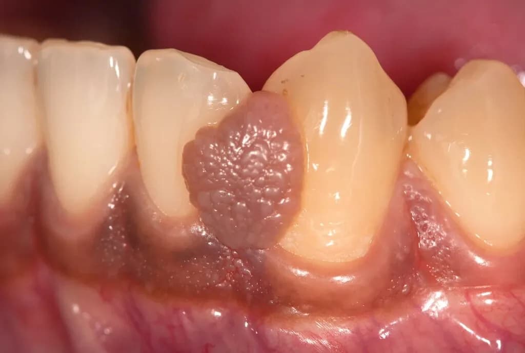 Jak zmniejszyć opuchliznę dziąsła i uniknąć bólu w jamie ustnej Jak zmniejszyć opuchliznę dziąsła i uniknąć bólu w jamie ustnej