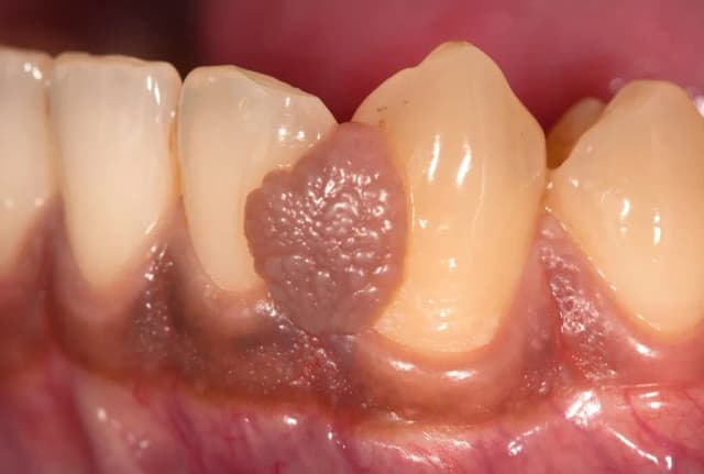 Jak zmniejszyć opuchliznę dziąsła i uniknąć bólu w jamie ustnej Jak zmniejszyć opuchliznę dziąsła i uniknąć bólu w jamie ustnej