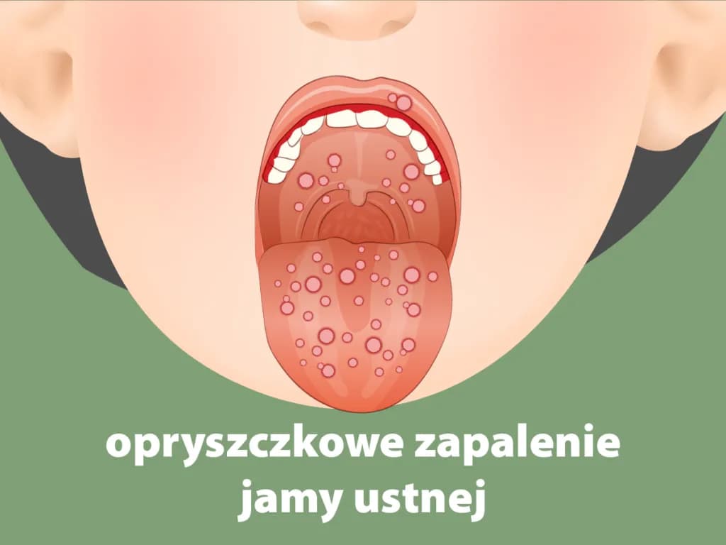 Skuteczne sposoby na zapalenie jamy ustnej u dziecka – ulga w bólu Skuteczne sposoby na zapalenie jamy ustnej u dziecka – ulga w bólu